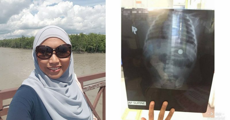 Doktor Ini Kongsi Kes Bayi Tertelan Bateri. Berisiko Menyebabkan Perut