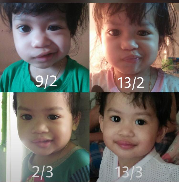 Mulut Dan Muka Senget, Saraf Telinga Dijangkiti Kuman 